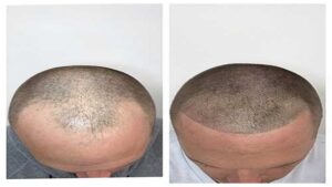 Hair Loss to Hair Confidence: PRP Therapy’s Role in Revitalizing Hair Density