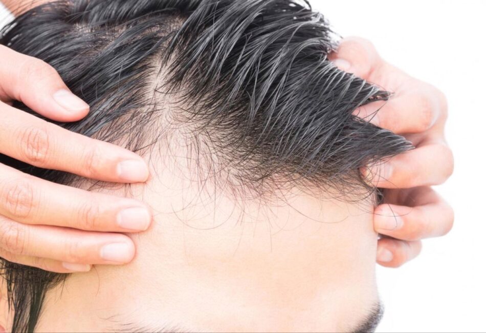 Risks and Complications of Hair Transplant in Riyadh