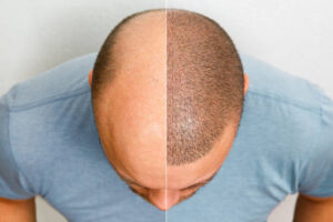 Hair Transplant in Dubai: Avoid These Common Mistakes