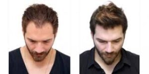 Hair Transplant Cost in Dubai: What Every Patient Should Know