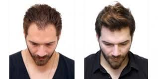Hair Transplant in Dubai: Choosing the Right Procedure for You