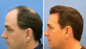 What Makes Hair Transplant in Dubai a Trusted Solution