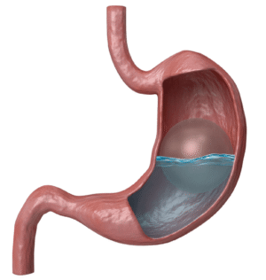 How often do people experience discomfort with a gastric balloon in Dubai?