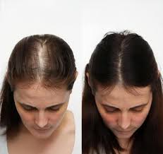 Is It Too Early to Consider a Hair Transplant If I’m Only in My 20s?