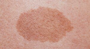 Laser Mole Removal Dubai: Best Dermatologist Picks