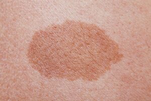 Laser Mole Removal Dubai: Best Dermatologist Picks