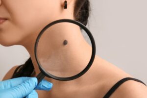Laser Mole Removal Treatment in Delhi: A Complete Informational Guide