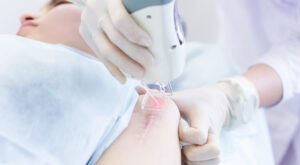 Laser Scar Removal Dubai Trusted Clinics & Surgeons