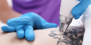 Understanding How Laser Tattoo Removal Works: A Complete Overview
