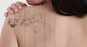 Laser Tattoo Removal: Personalized Treatment Plans