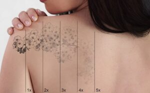 Laser Tattoo Removal: Personalized Treatment Plans