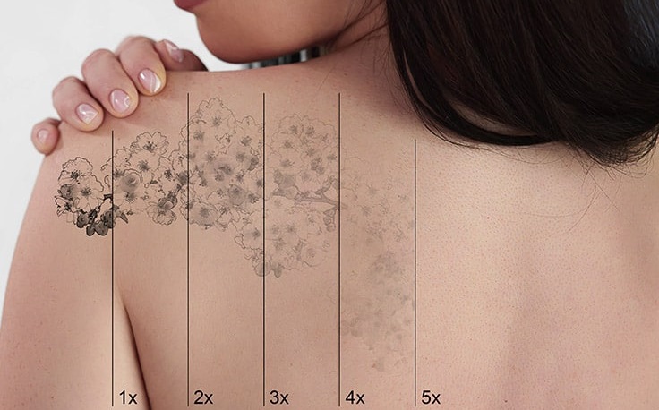 Laser Tattoo Removal: Personalized Treatment Plans