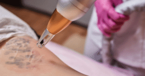 Picosure Tattoo Removal Advanced Laser for Smooth Clear Skin