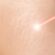 Everything You Need to Know About Laser Stretch Marks Treatment