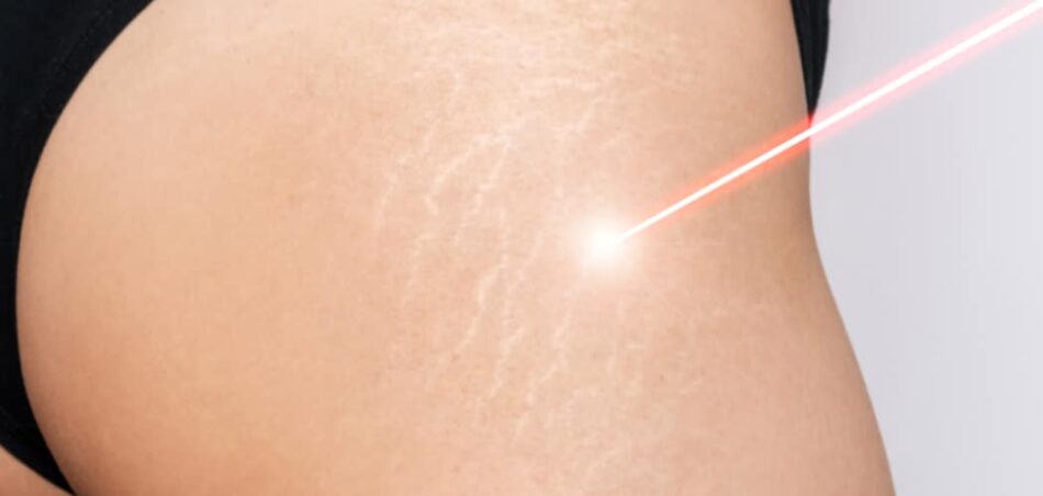 Everything You Need to Know About Laser Stretch Marks Treatment