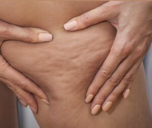 Holistic Lipedema Recovery Programs in Riyadh