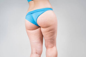 Lipedema Treatment Plans That Address Pain and Inflammation
