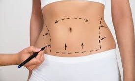 Liposuction in Dubai?
