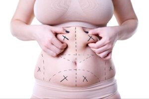 Liposuction vs. CoolSculpting – Which Fat Removal Treatment Is Right for You?