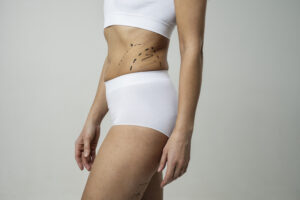 Results Begin with Best Liposuction Cosmetic Surgeon in Dubai