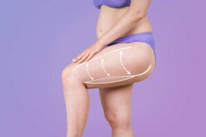 Essential Tips for Choosing Liposuction in Riyadh Safely and Wisely
