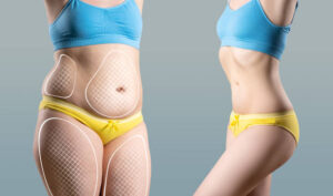 Quick Liposuction Recovery Riyadh