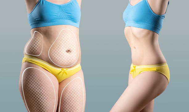 Quick Liposuction Recovery Riyadh