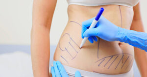 Dubai Liposuction: How to Avoid Common Mistakes