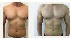 Who Is an Ideal Candidate for Liposuction Surgery in Dubai?