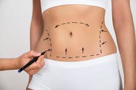 Liposuction in Dubai?
