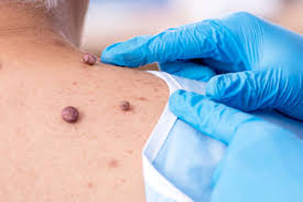 What to Expect During and After a Mole Removal in Dubai Procedure