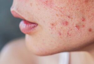 Pimples Treatment in Dubai: Minimally Invasive Options