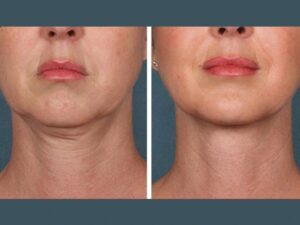 Best Plastic Surgeon in Dubai PRP Treatment for Celebrity Glow