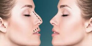 Insights into Non-Surgical vs Surgical Rhinoplasty in Riyadh Options