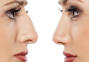 Septoplasty and Rhinoplasty Combination Treatments in Riyadh