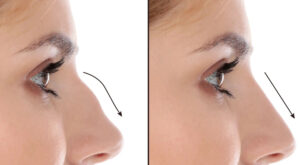 Septoplasty in Dubai
