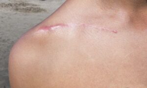 Scar Removal in Dubai: How to Maintain Results Long-Term