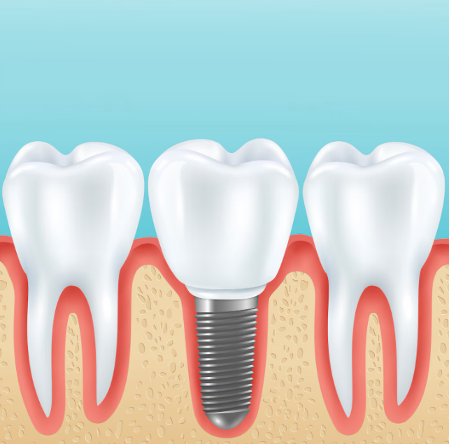 Is a Same-Day Dental Implant Right for You? Key Considerations