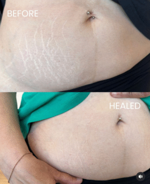 Stretch Mark Camouflage Eagleville – Restore Smooth, Radiant Skin with Inkless Stretch Mark Revision