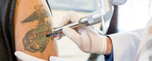 Tattoo Removal in Dubai: Affordable Laser Sessions for All Budgets