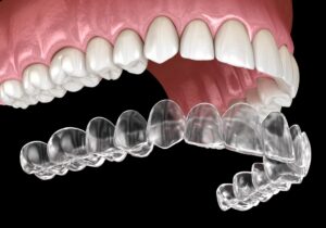 Signs You May Be A Perfect Candidate For Aligners Treatment