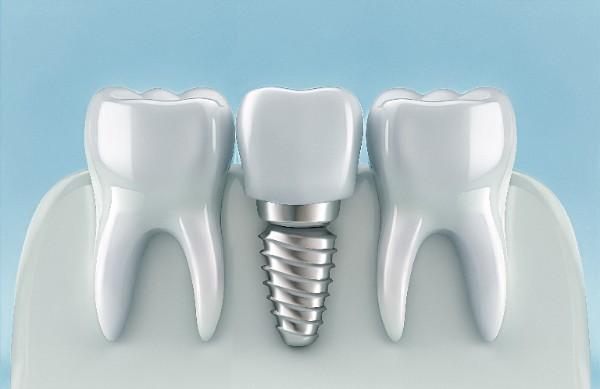 dental implants Bury