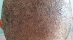 Hair Transplant Dubai: Guide to Cost and Recovery