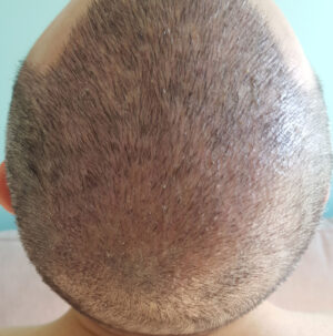 Hair Transplant Dubai: Guide to Cost and Recovery