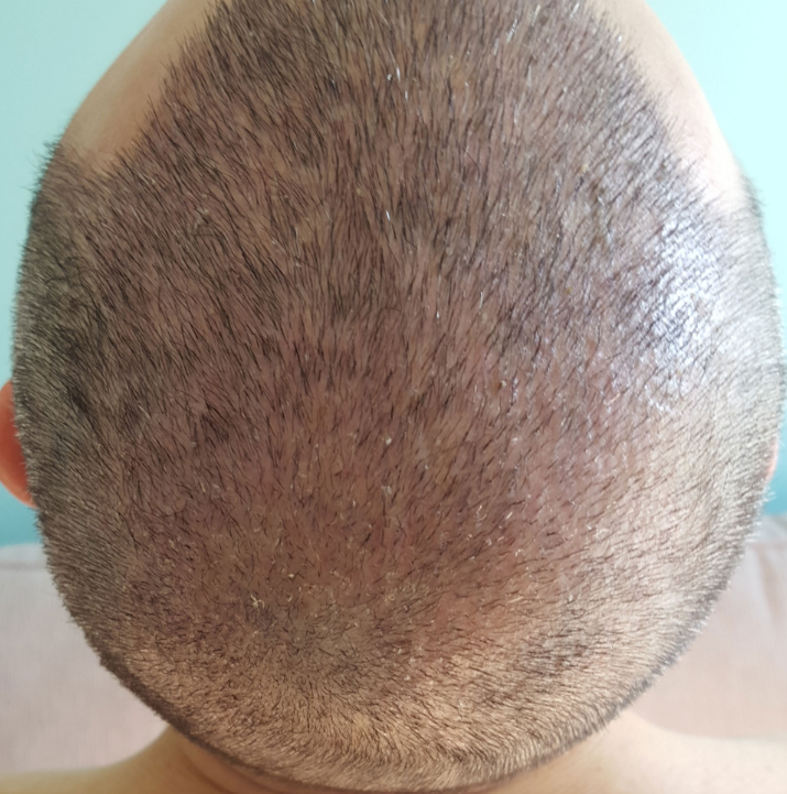Hair Transplant Dubai: Guide to Cost and Recovery