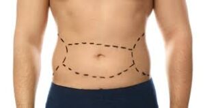 Tummy Tuck Surgery in Dubai: Ideal Candidates and Suitability Factors
