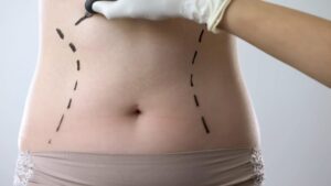 Is Tummy Tuck the Right Choice for You to Regain Confidence