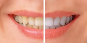 Achieve Guaranteed Results with Enlighten Teeth Whitening London