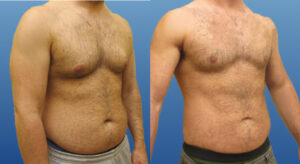 What Are the Best Aftercare Practices Following Liposuction in Dubai?