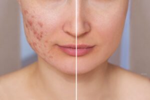 What Should You Avoid After Acne Scar Treatment in Dubai?